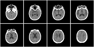 Dyskinesia-hyperpyrexia syndrome in Parkinson's disease triggered by overdose of levodopa — a case report and literature review